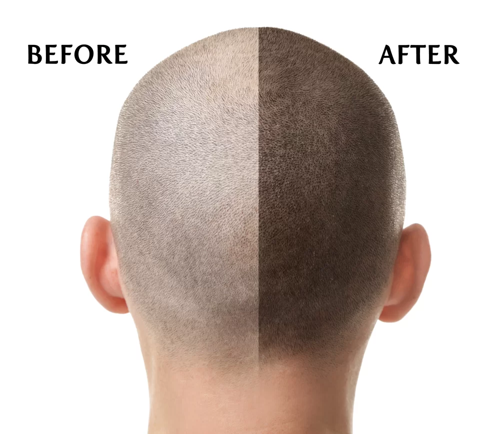 Scalp_micropigmentation_in_Delhi