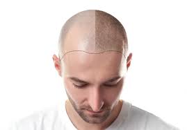 Scalp pigmentation services in Mumbai